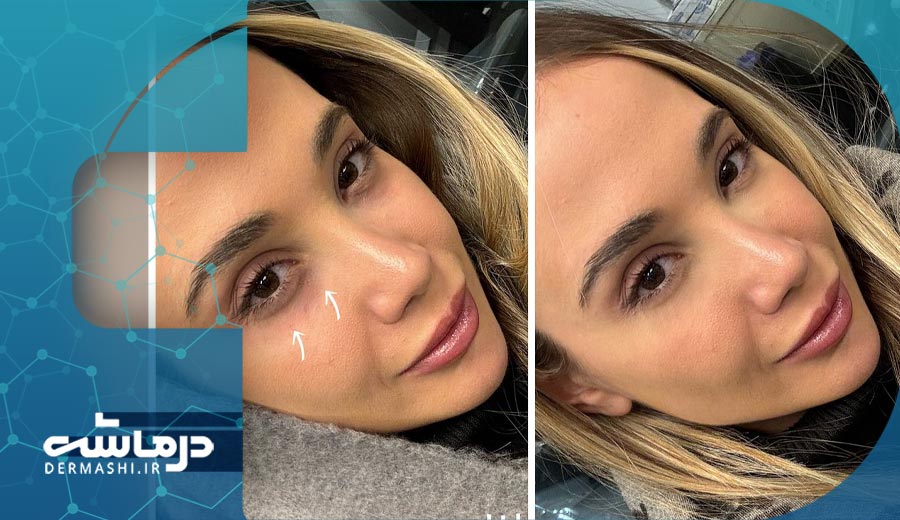 بهترین فیلر زیر چشم